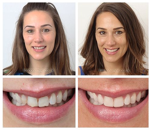https://www.colinadental.com/services/costa-rica-porcelain-veneers/