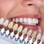 Creating Radiant Transformations Through Skilled Porcelain Veneer Applications