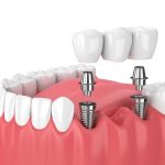 How Dental Implants Facilitate Faster Recovery Times Compared to Traditional Extraction and Bridge Procedures
