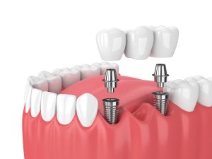 How Dental Implants Facilitate Faster Recovery Times Compared to Traditional Extraction and Bridge Procedures