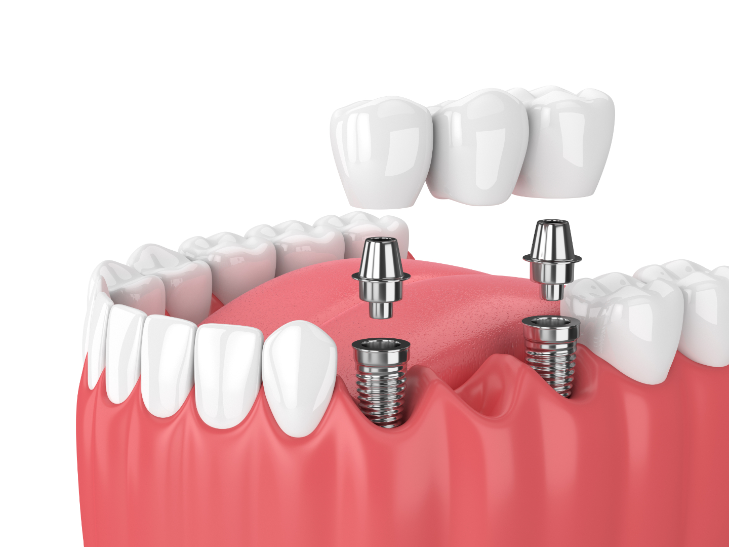 How Dental Implants Facilitate Faster Recovery Times Compared to Traditional Extraction and Bridge Procedures